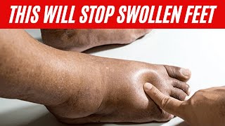 Home Remedies for Swollen Feet  Edema Remedy [upl. by Ddet]