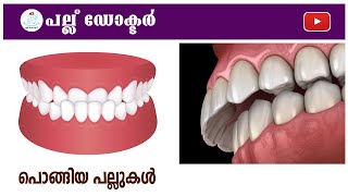 പൊങ്ങിയ പല്ലുകൾ  quotForward Teeth Understanding the Structure and Function of Incisorsquot [upl. by Jenica]