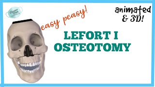 LEFORT I OSTEOTOMY  MAXILLARY OSTEOTOMY [upl. by Irollam]