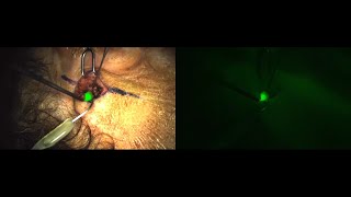 Melanoma Sentinel Lymph Node Biopsy Guided By a Fluorescent Probe [upl. by Ahsenrad]