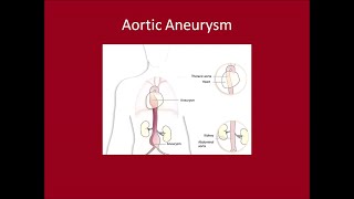 Management of Aortic Aneurysms [upl. by Lehcear]