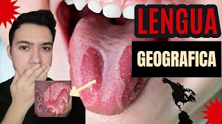 ¿Qué es la lengua geográfica  glositis migratoria benigna  Causas y tratamientos 👈😲 [upl. by Pallua]