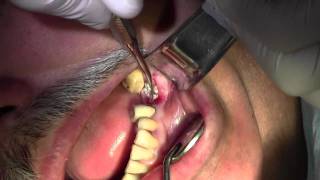 Extraction 18 with Simple Socket Bone Grafting [upl. by Jemie320]