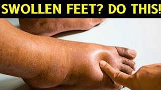 Home Remedies To Cure Swollen Feet and Ankle FAST [upl. by Pinchas]