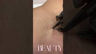 Ingrown Hair Removal [upl. by Hennie]