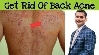 Get Rid Of Back Acne Bacne in 10 Days  100 Natural Treatment for Back Acne [upl. by Romano]