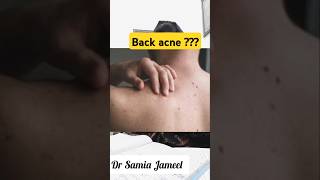 Back acne easy solution by Dr Samia Jameel viralvid viralvideos viralposts viralnow viraltrend [upl. by Huggins617]