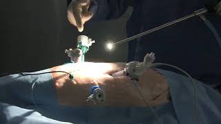 Gas Aerosol Jetstreams from Trocars during Laparoscopic Surgery A Video Vignette [upl. by Aihsital]