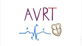 Atrioventricular Reentrant Tachycardia AVRT SVT ECGTUTORIAL cardiology medicalstudents AVNRT [upl. by Heater]