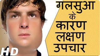 गलसुआ  कारण लक्षण और उपचार Prevention of mumpsMumps –Causes symptoms and treatment amphealth tips [upl. by Kone]