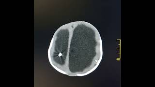 Severe obstructive hydrocephalus and non functioning VP shunt [upl. by Hnah20]