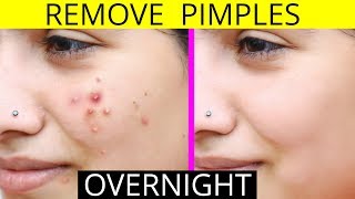 How To Remove Pimples Overnight  Acne Treatment  Anaysa [upl. by Araic]