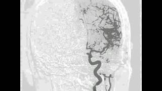 Brain aneurysm angiogram [upl. by Ayle]