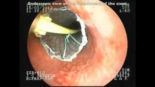 Positioning without fluorscopic esophageal SEMS [upl. by Omidyar965]