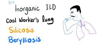 Silicosis Berylliosis amp Coal Workers Pneumoconiosis  Interstitial Pulmonary FibrosisLung Disease [upl. by Herta771]