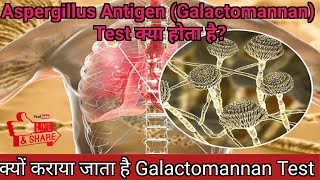 Aspergillus Antigen Galactomannan Test in Hindi  एसपरजिलस एंटीजन गैलेक्टोमेनन टेस्ट क्या है [upl. by Lira]