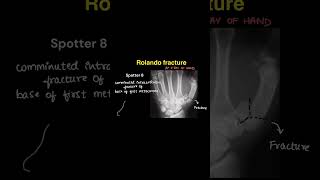 Radiology spotters on our YouTube channel radiologycases spotters neet neetpg pediatrics xray [upl. by Pedroza]