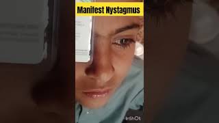 manifest Nystagmus  nystagmus eyediseases [upl. by Kellina]