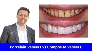 Porcelain Veneers Vs Composite Veneers Which is Best [upl. by Inot96]