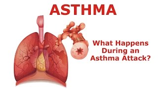 Asthma  What Happens During an Asthma Attack [upl. by Dekow]