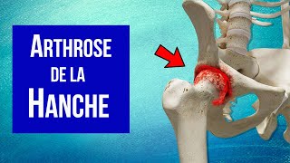 Arthrose de la hanche  Explication et Traitement [upl. by Eednahs786]