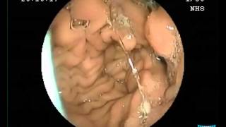 Gastric Diverticula [upl. by Yelir]