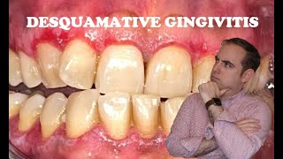 Essential Differential Desquamative Gingivitis [upl. by Aissac679]