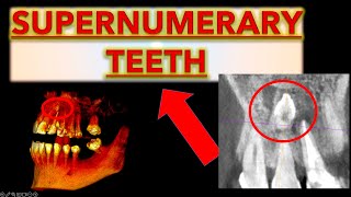 How to Make Sure it is a Supernumerary Tooth Extra teeth in mouth hyperdontia extra front teeth [upl. by Llenrahs167]