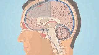 Understanding Subarachnoid Hemorrhage [upl. by Nave]