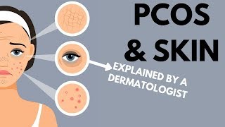 PCOS amp Skin  Dermatologist Review [upl. by Ynohtna981]