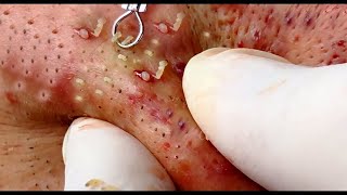 How to use a blackhead removal tool 2021 [upl. by Trill]