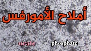 املاح الامورفس في البول amorphous urate amp phosphate in urine [upl. by Eahs53]