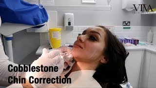 Cobblestone Chin Correction  VIVA Skin Clinics [upl. by Nara]