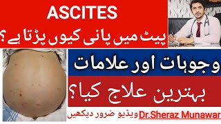 What is Ascites Causes  Symptoms and Best Treatment  پیٹ میں پانی کیوں پڑ جاتا ہے [upl. by Cherry]