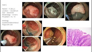 ESD and EMR of Lesion of GI Tract  Todua Clinic [upl. by Nanni317]