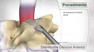 Disectomía cervical anterior [upl. by Crofton405]