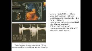 CARDIOLOGIE INSUFFISANCE MITRALE [upl. by Kan414]