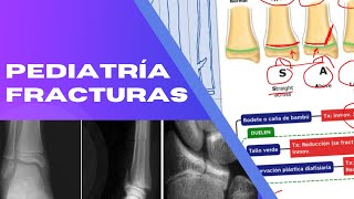 PEDIATRIA FRACTURAS [upl. by Pellet]