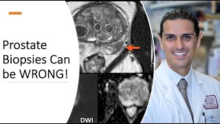 Prostate Biopsies Can Be WRONG  Dr Ahdoot Explains Prostate Cancer Diagnosis [upl. by Brittani]