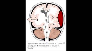 Herniation Syndromes  Cingulate subfalcine Transtentorial Uncal amp Cerebellar Tonsillar [upl. by Ammann]