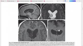 CORE REQUISITES of neuroradiology [upl. by Eglantine]