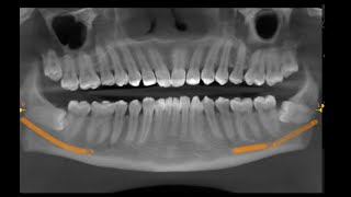 17 Surgical Extraction of Impacted Wisdom Teeth [upl. by Herwin]