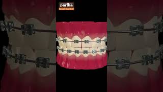 Teeth Braces Treatment at Partha Dental [upl. by Daigle]