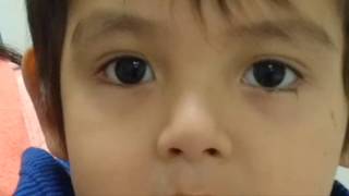 Nystagmus Video Pelizaeus Merzbacher [upl. by Perce]