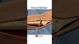 Hand bone fracture treatment  3D animation [upl. by Lesig876]