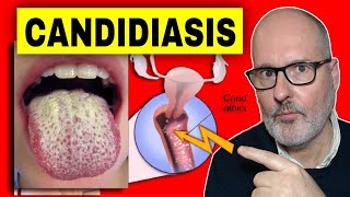 Qué es la CÁNDIDA y Cómo se CURA la CANDIDIASIS [upl. by Acilegna]