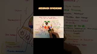 webersyndrome clinicalneuroanatomy midbrain [upl. by Ynned253]