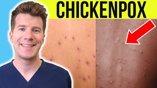 Doctor explains CHICKENPOX  Causes Stages Symptoms Treatment PLUS PHOTOS [upl. by Annay]