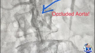 Occluded Aorta infrarenal CTO Revascularization of Aorta and Iliac artery  Lithotripsy amp stent [upl. by Antoinetta]