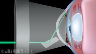 Laser Trabeculoplasty for Glaucoma ALT vs SLT Animation [upl. by Nylegna]